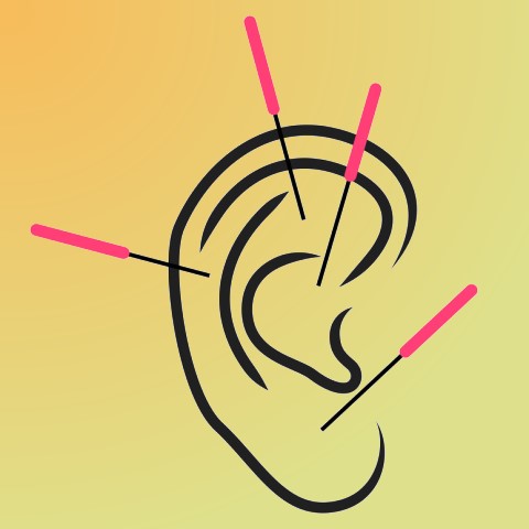 ear acupuncture - five needle protocol - 5np